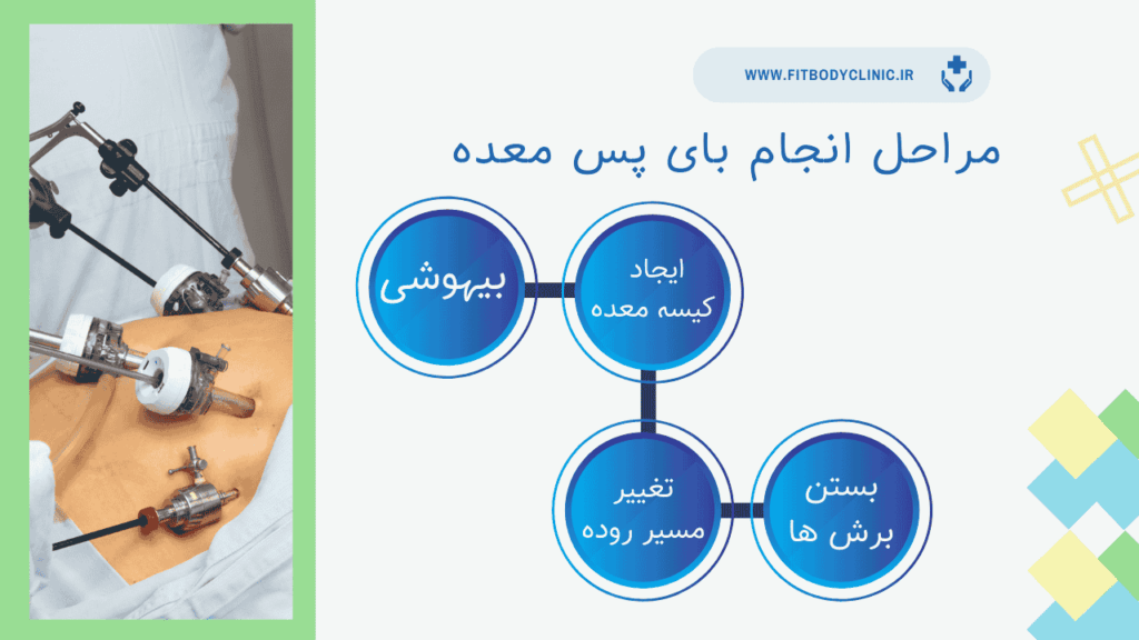 مراحل انجام بای پس معده