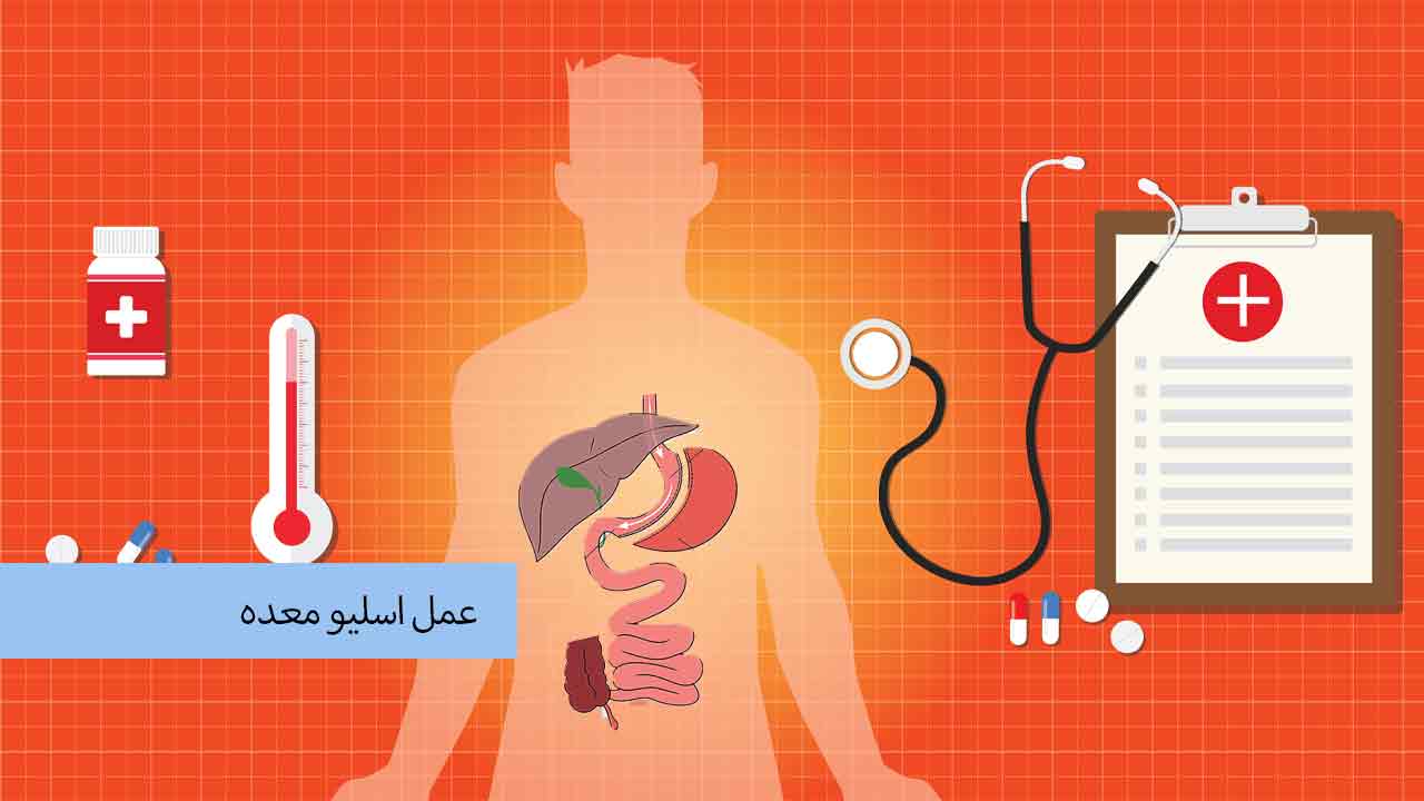 عمل اسلیو معده