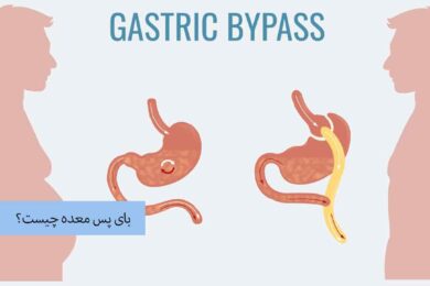 عمل بای پس معده چیست؟