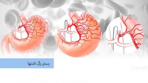 بستن رگ اشتها