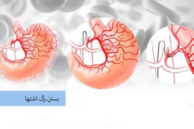 بستن رگ اشتها