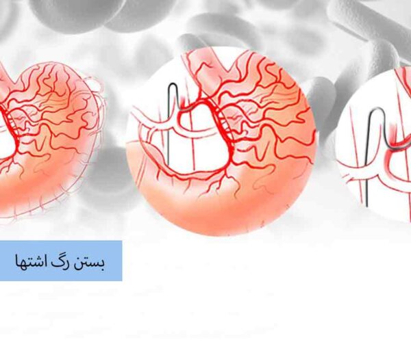 بستن رگ اشتها