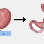 مینی بای پس معده