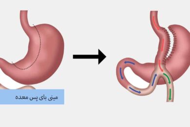 مینی بای پس معده