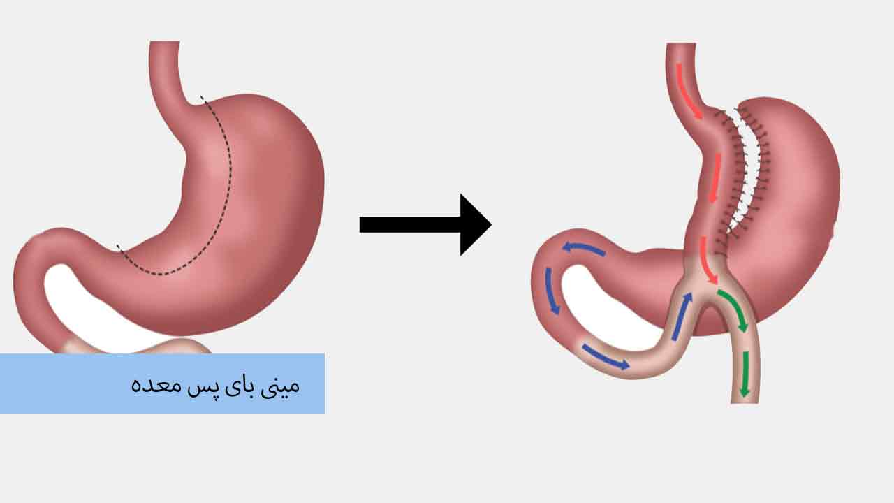 مینی بای پس معده