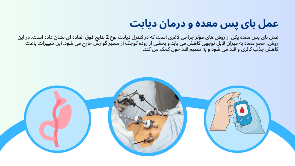 درمان دیابت نوع 2 با بای پس معده