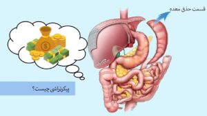 هزینه اسلیو معده