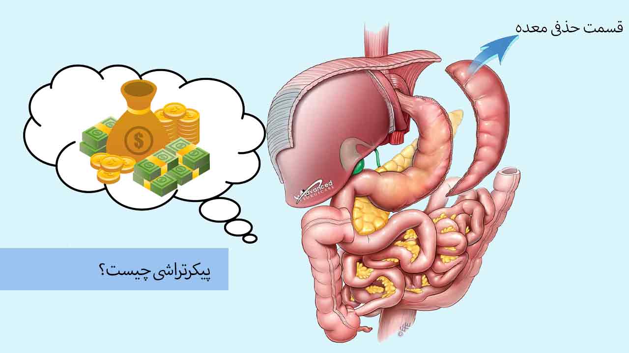 هزینه اسلیو معده